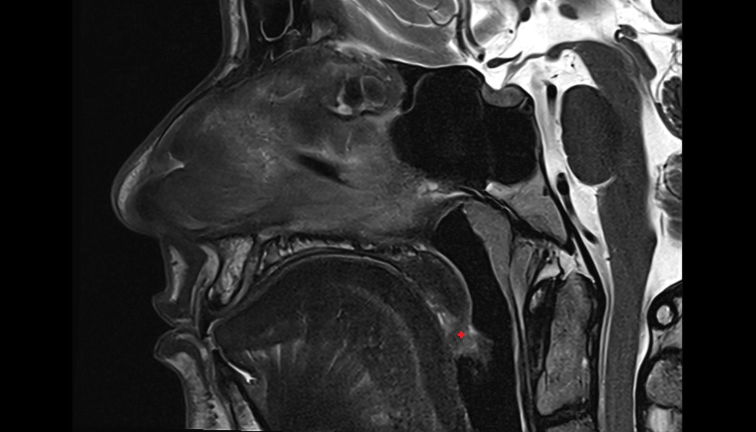Uvula of palate mri sag image -img-00000-00000