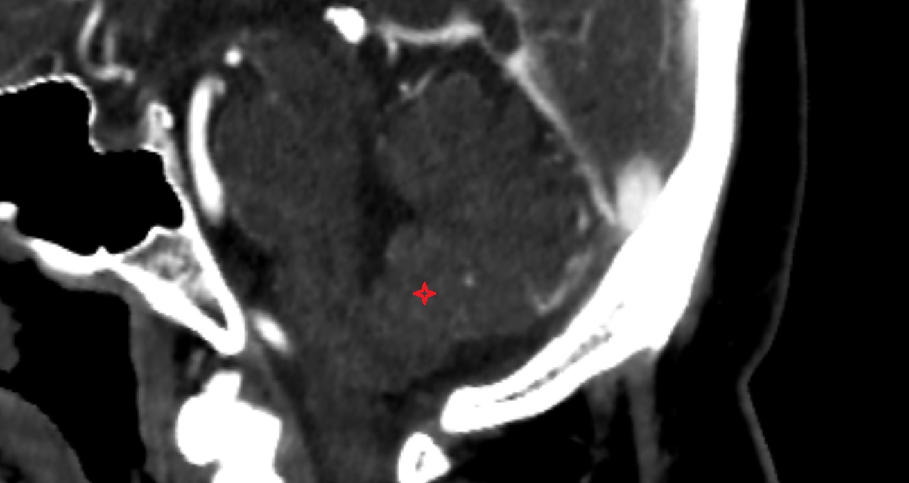 Uvula of vermis  CT axial anatomy image -img-00001-00001