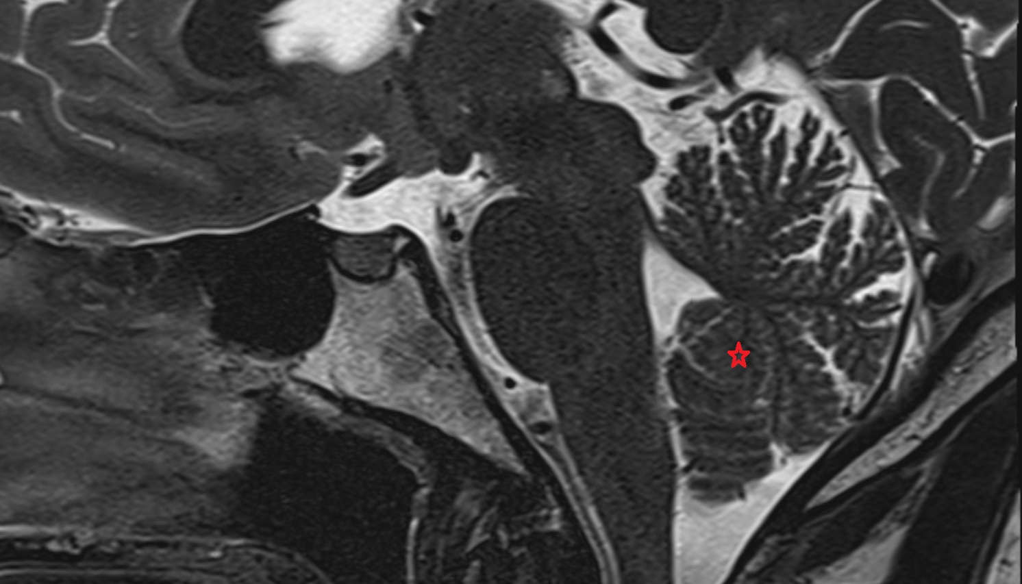 Uvula of vermis (IX)  of Cerebellum mri sag  image -img-00000-00000