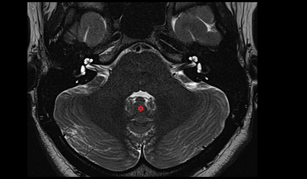 Uvula of vermis MRI axial 3T image