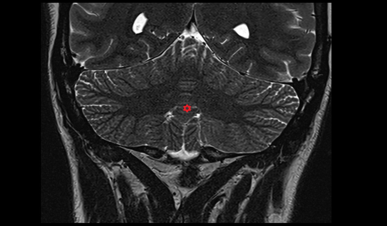 Uvula of vermis MRI coronal 3T image