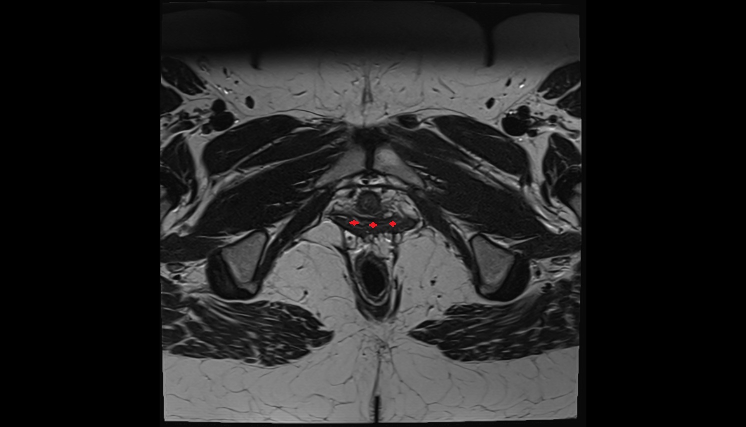 Vagina  MRI axial  image anatomy  image-img-00000-00000