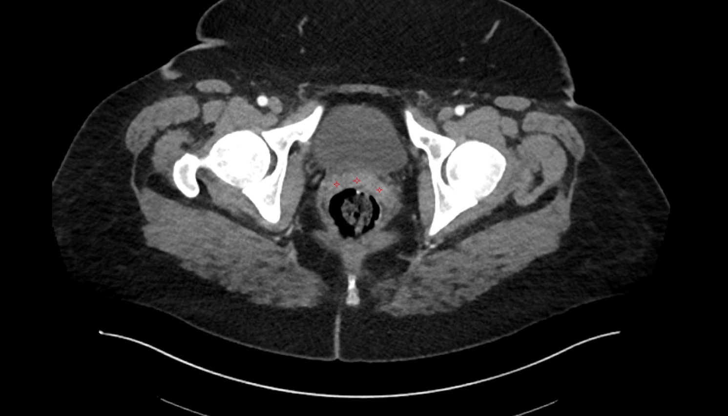 Vagina  ct axial  image anatomy  image-img-00000-00000