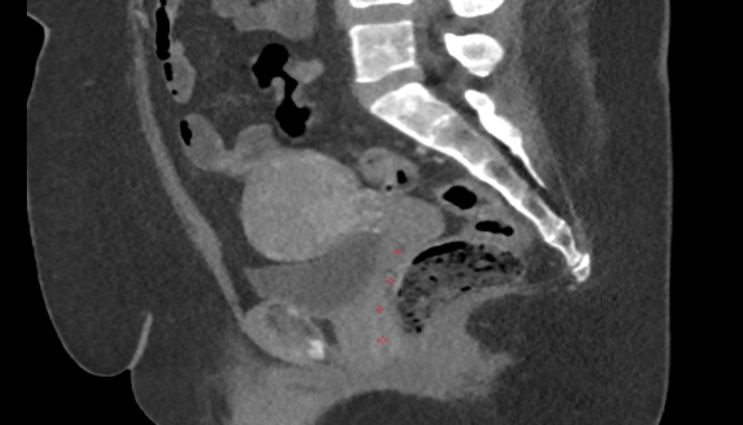 Vagina  ct  sagittal  image anatomy  image-img-00000-00000