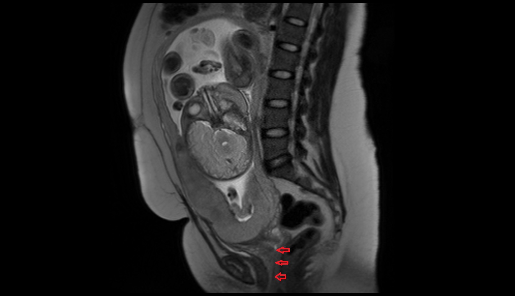 Vagina in Pregnancy mri sagittal image