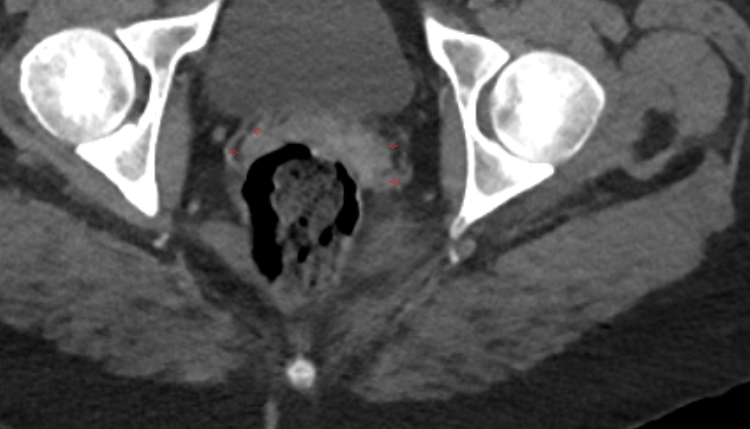 Vaginal venous plexus  CT  axial  anatomy  image-img-00000-00000