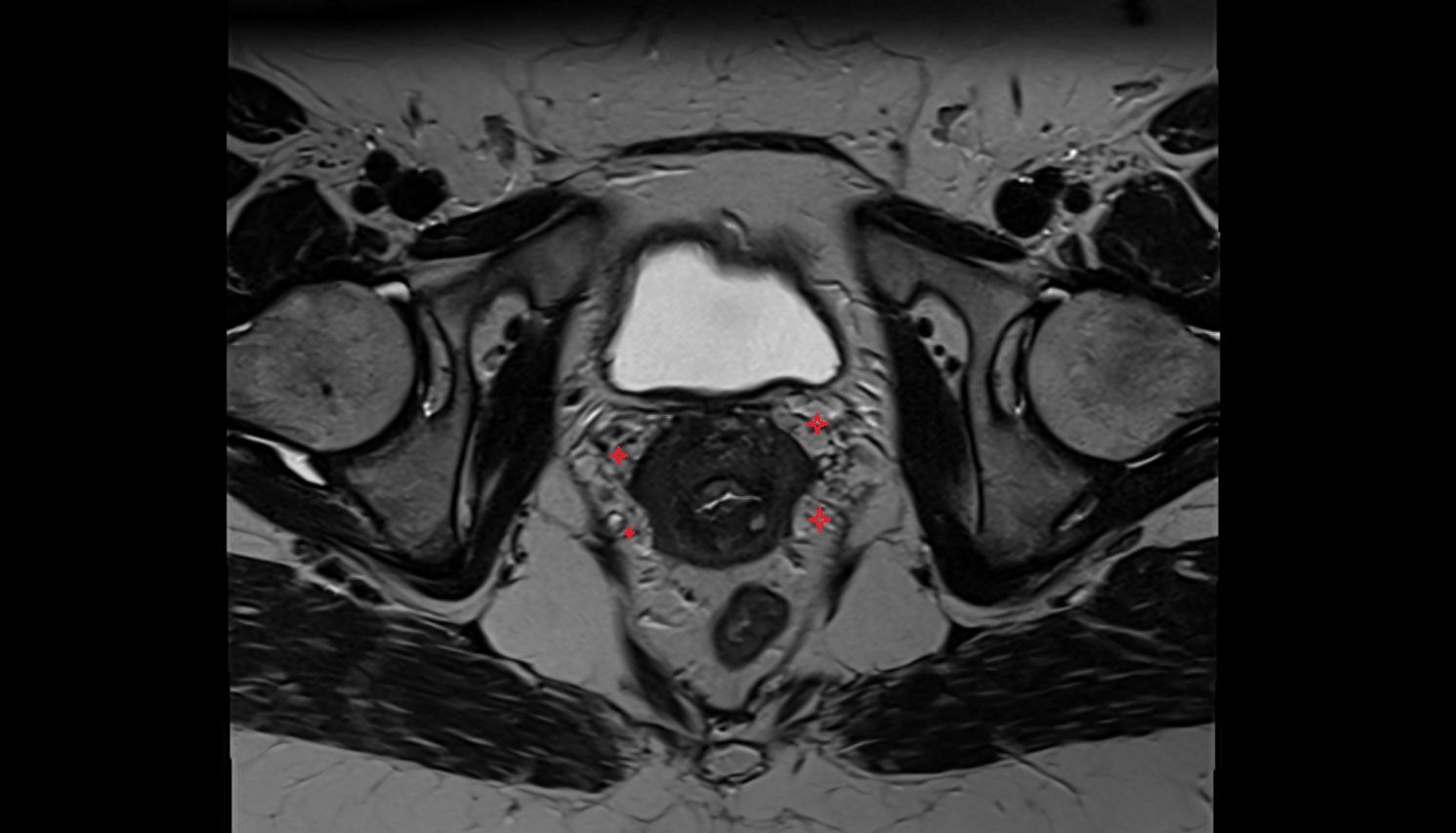 Vaginal venous plexus MRI  axial  anatomy  image-img-00000-00000