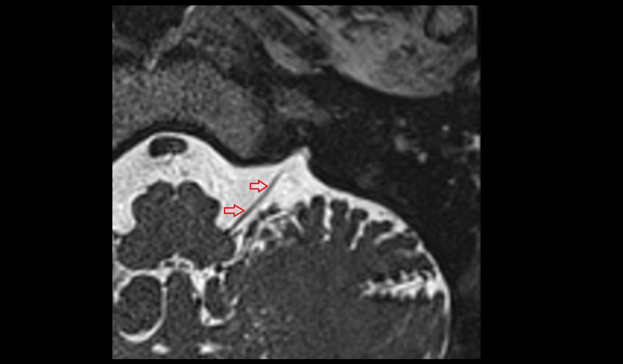 Vagus nerve (Cranial nerve X) MRI 3T axial image