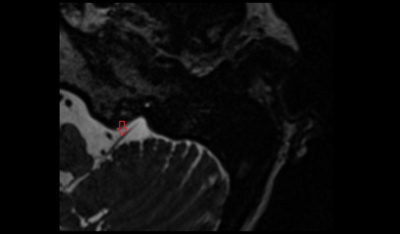 Vagus nerve (Cranial nerve X) MRI 3T axial image 1
