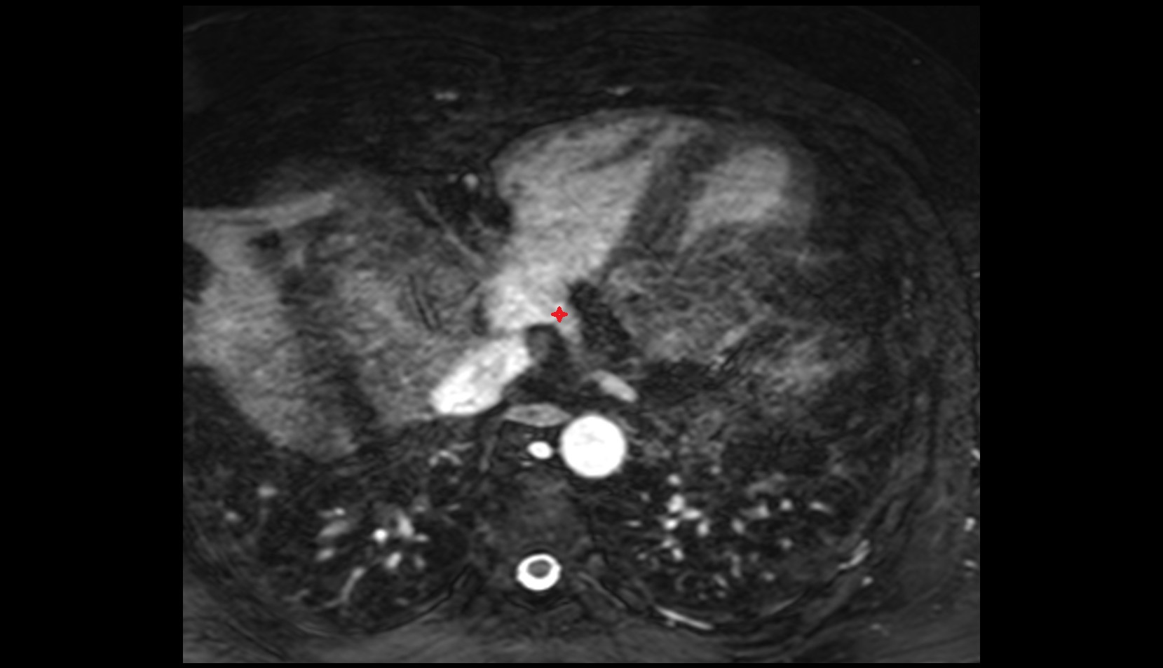 Valve of coronary sinus MRI axial image