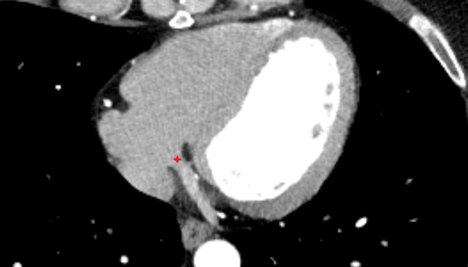 Valve of coronary sinus anatomy  CT  axial image -img-00000-00000