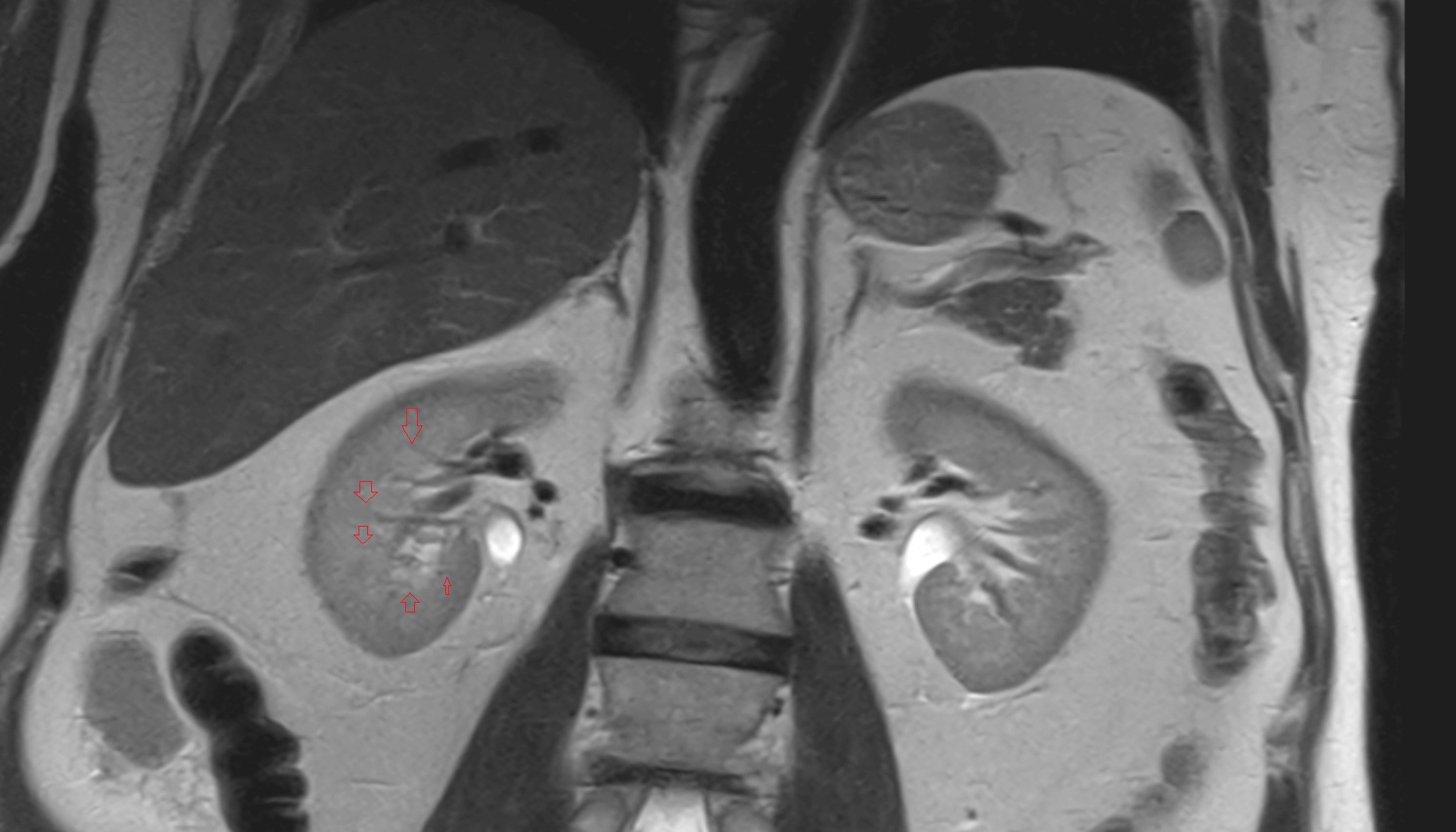 Vasa recta (kidney)  MRI coronal  anatomy  image -img-00000-00000