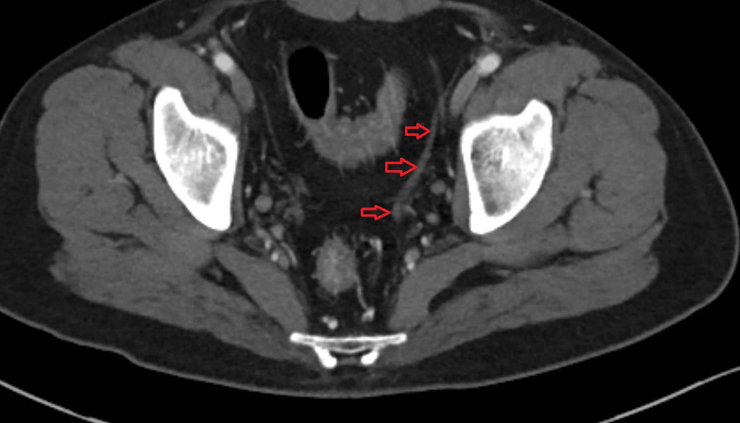 Vas deferens  CT axial anatomy  image-img-00000-00000