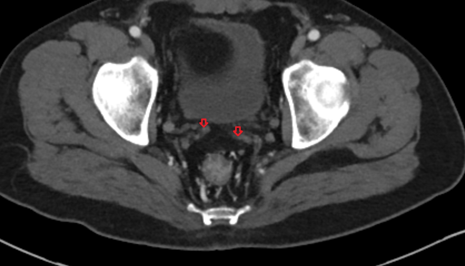 Vas deferens  CT axial anatomy  image-img-00000-00000_00001