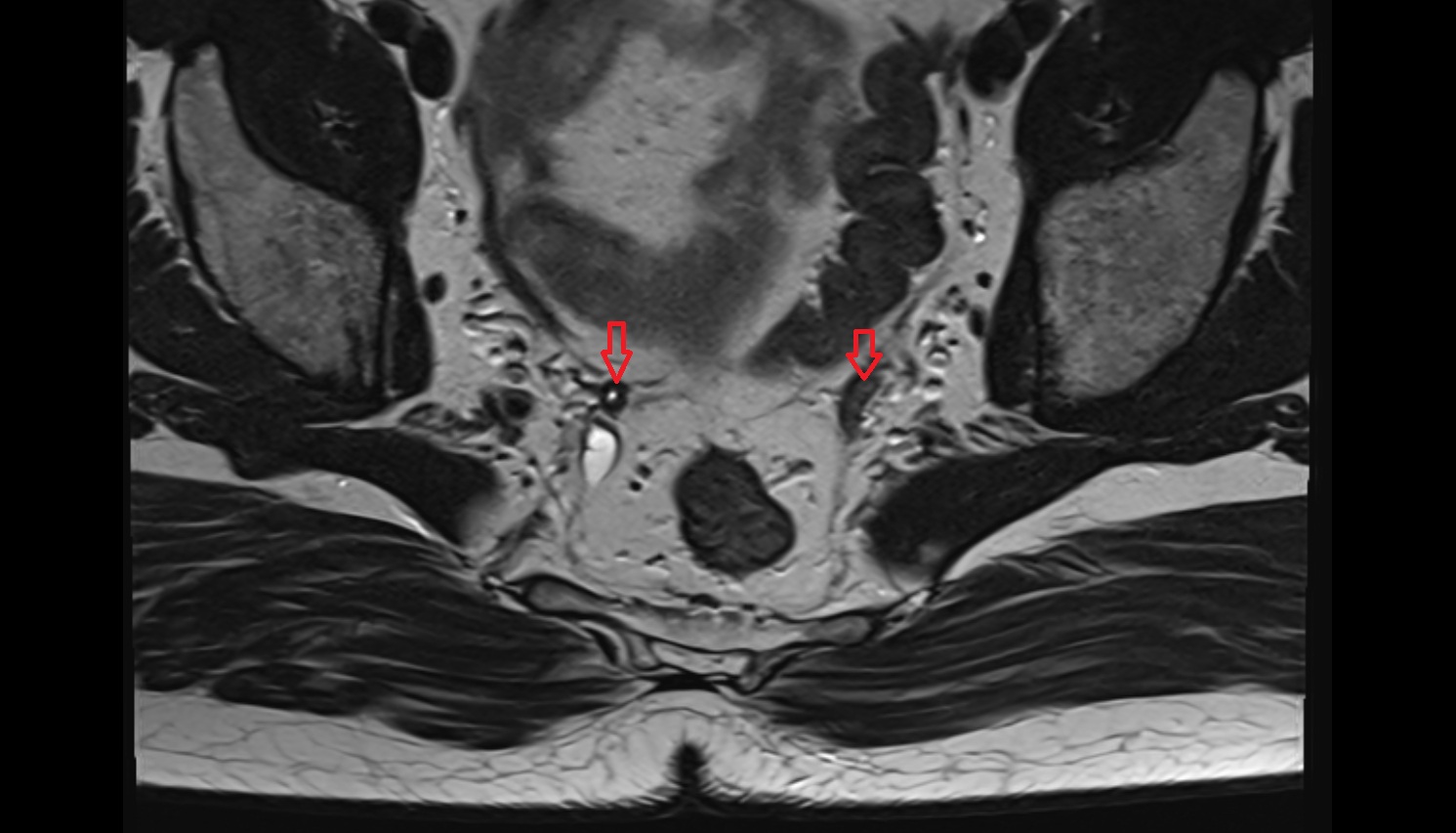Vas deferens  MRI axial anatomy  image-img-00000-00000