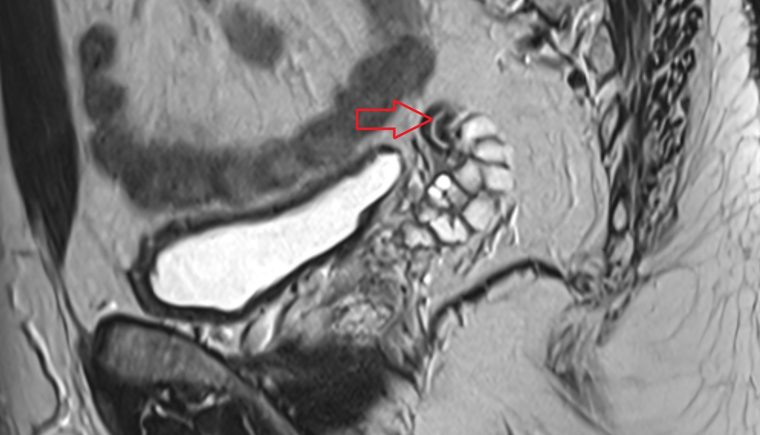 Vas deferens  MRI axial sagittal  image-img-00000-00000