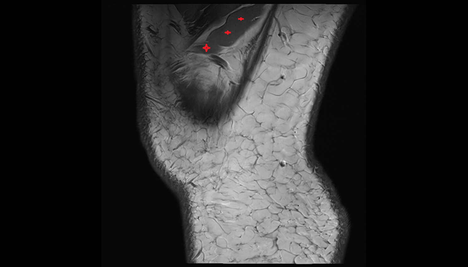 Vastus Lateralis Obliquus Muscle sag  cross sectional anatomy 3T radiology  anatomy image-img-00000-00000