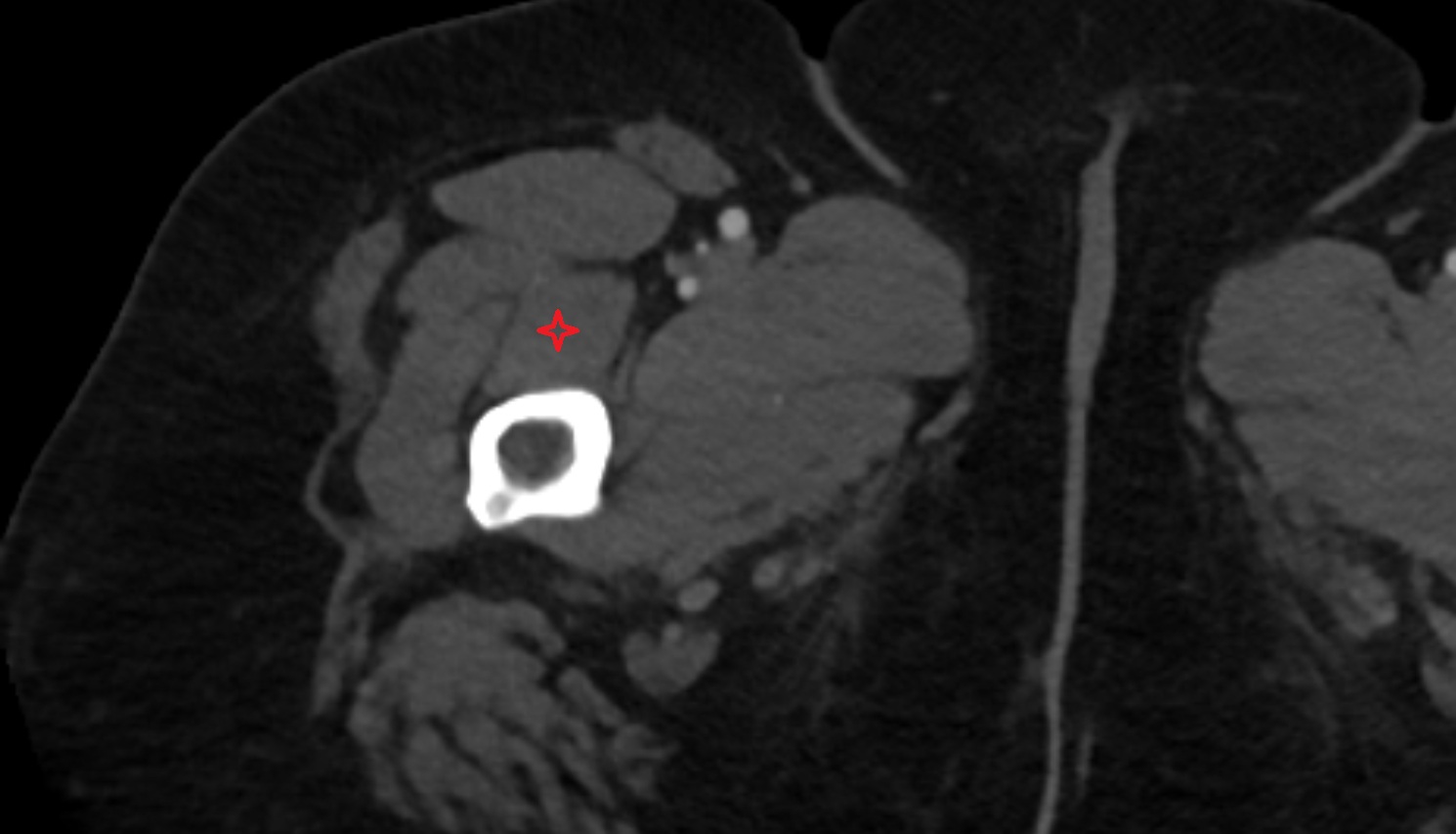 Vastus intermedius muscle  CT  axial  anatomy image-img-00000-00000