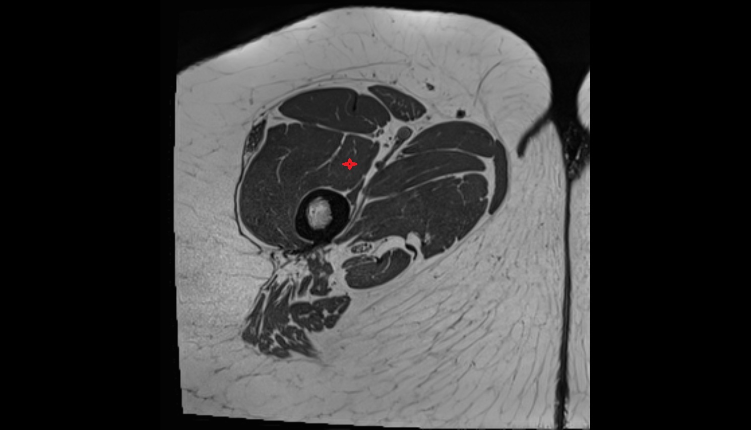 Vastus intermedius muscle  MRI  axial  anatomy image-img-00000-00000