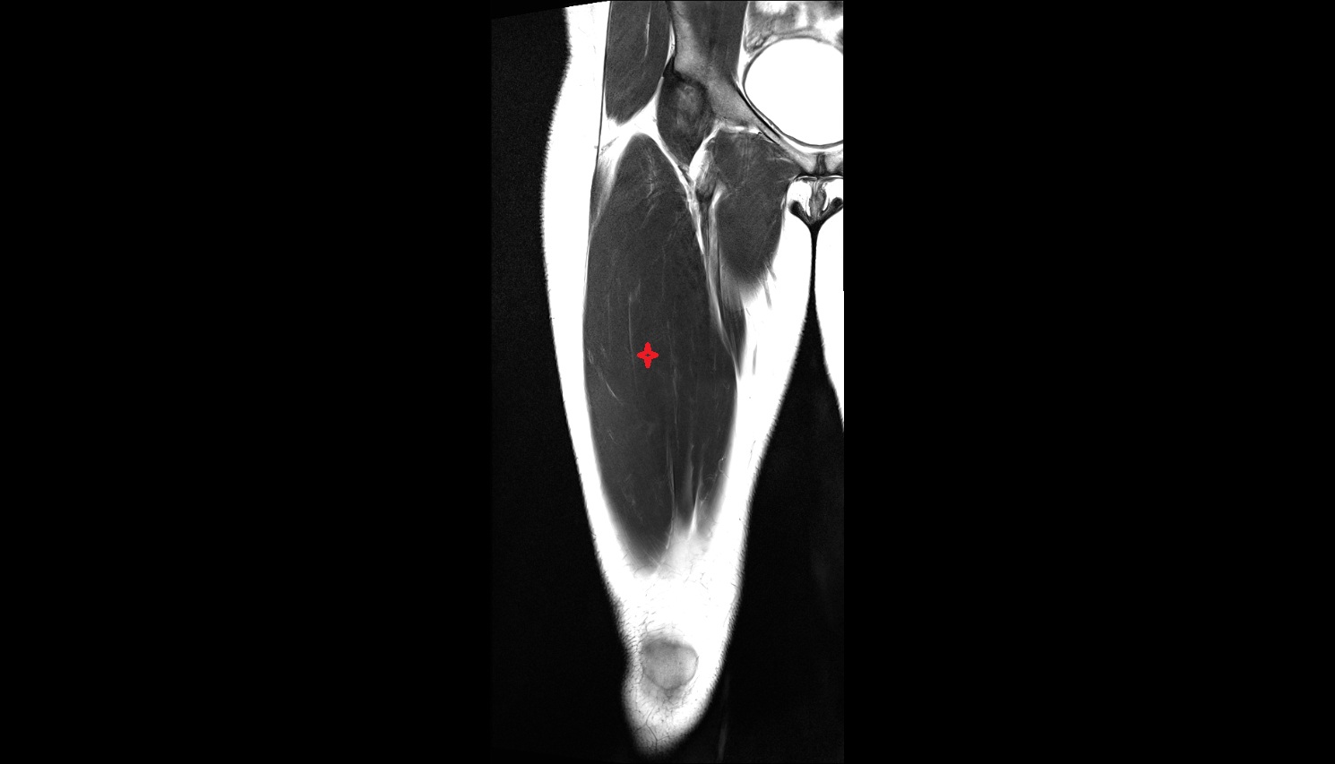 Vastus intermedius muscle  MRI  axial  anatomy image-img-00000-00000_00001
