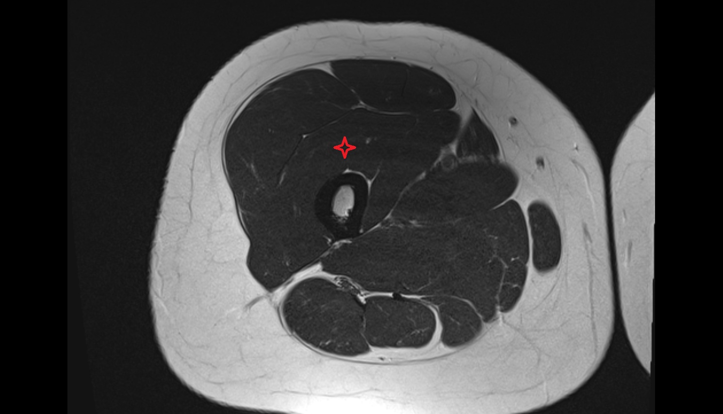 Vastus intermedius muscle  MRI  axial  anatomy image-img-00000-00000_00002