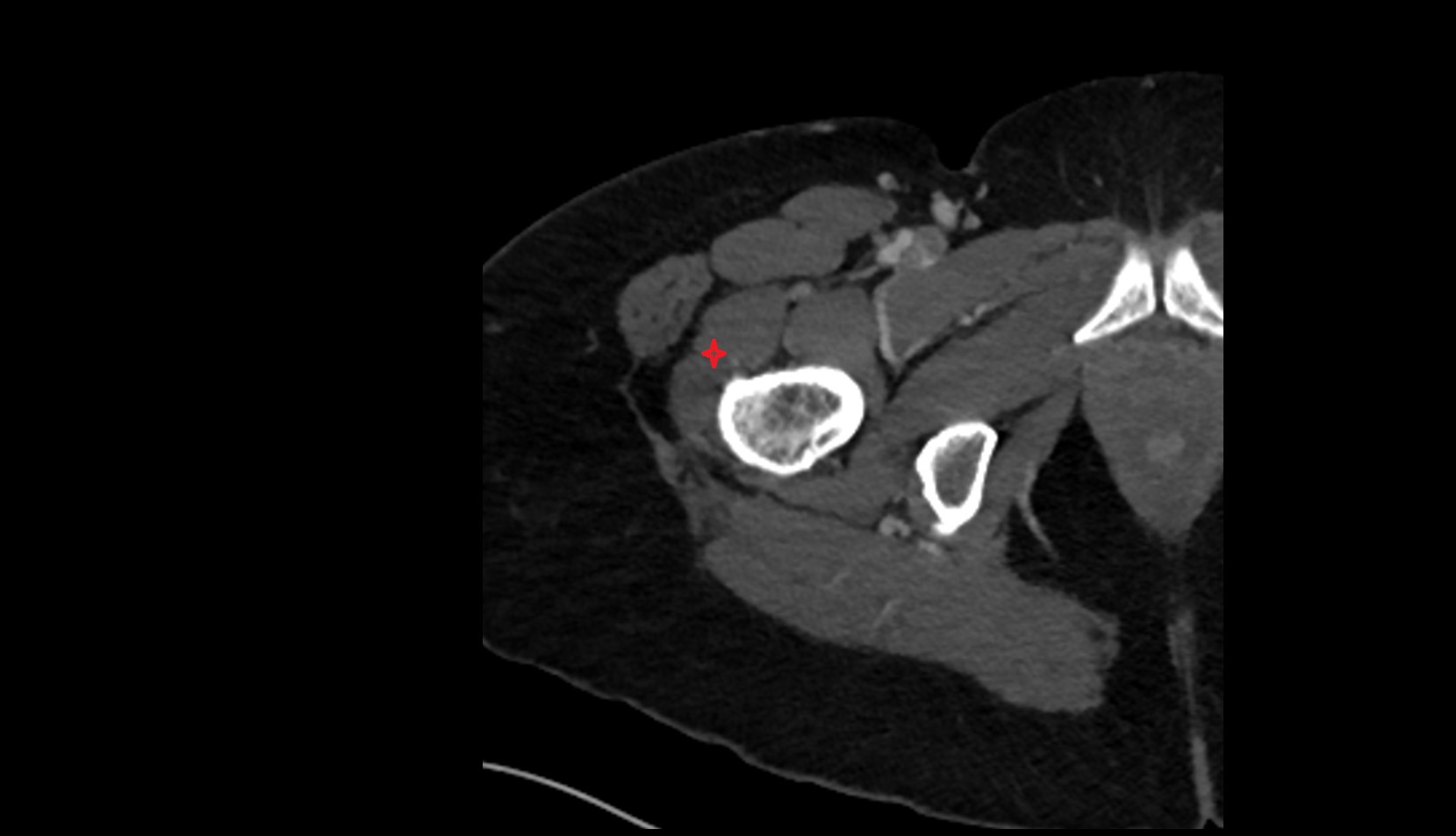Vastus lateralis muscle