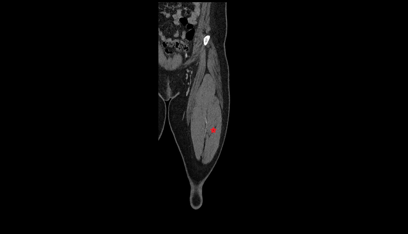 Vastus lateralis muscle ct coronal
