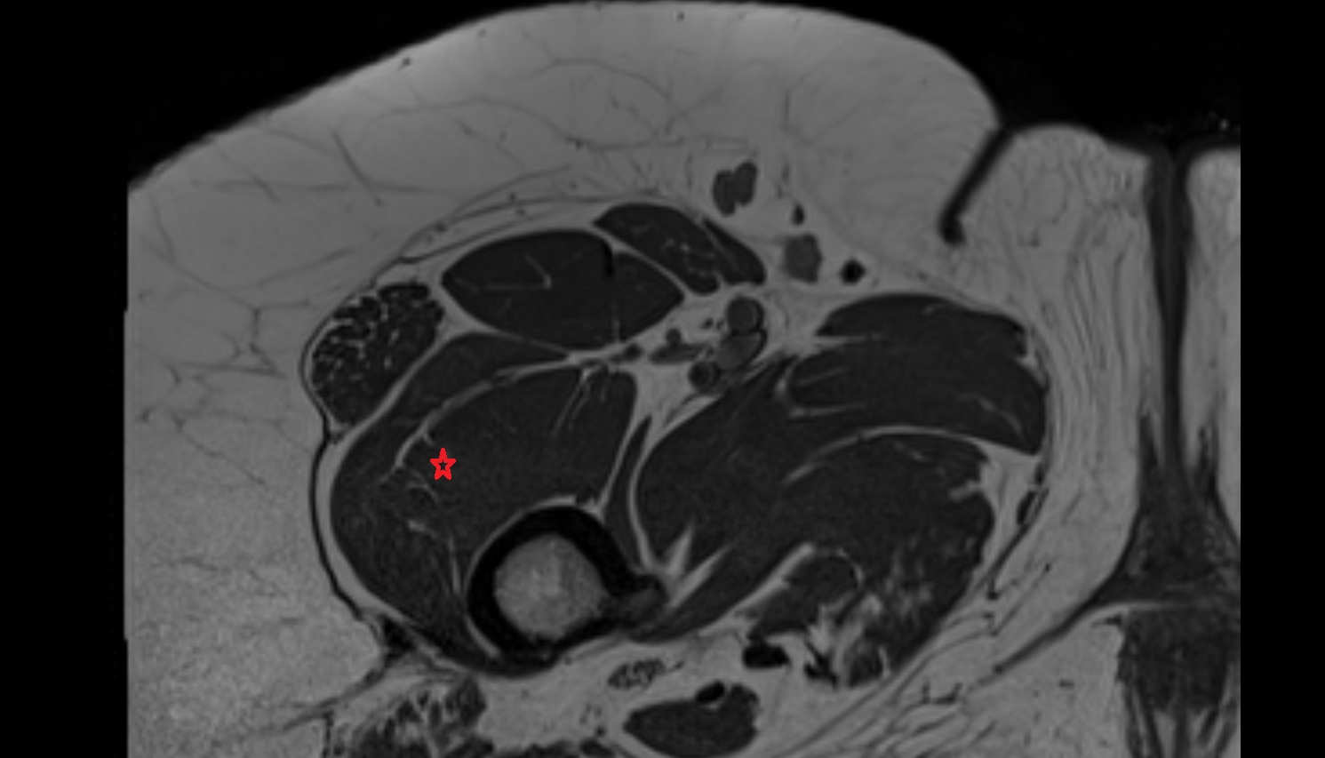 Vastus lateralis muscle mri axial  anatomy  image-img-00000-00000_00001