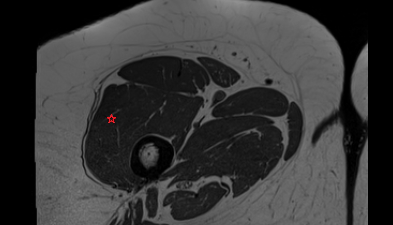 Vastus lateralis muscle mri axial  anatomy  image-img-00000-00000_00002