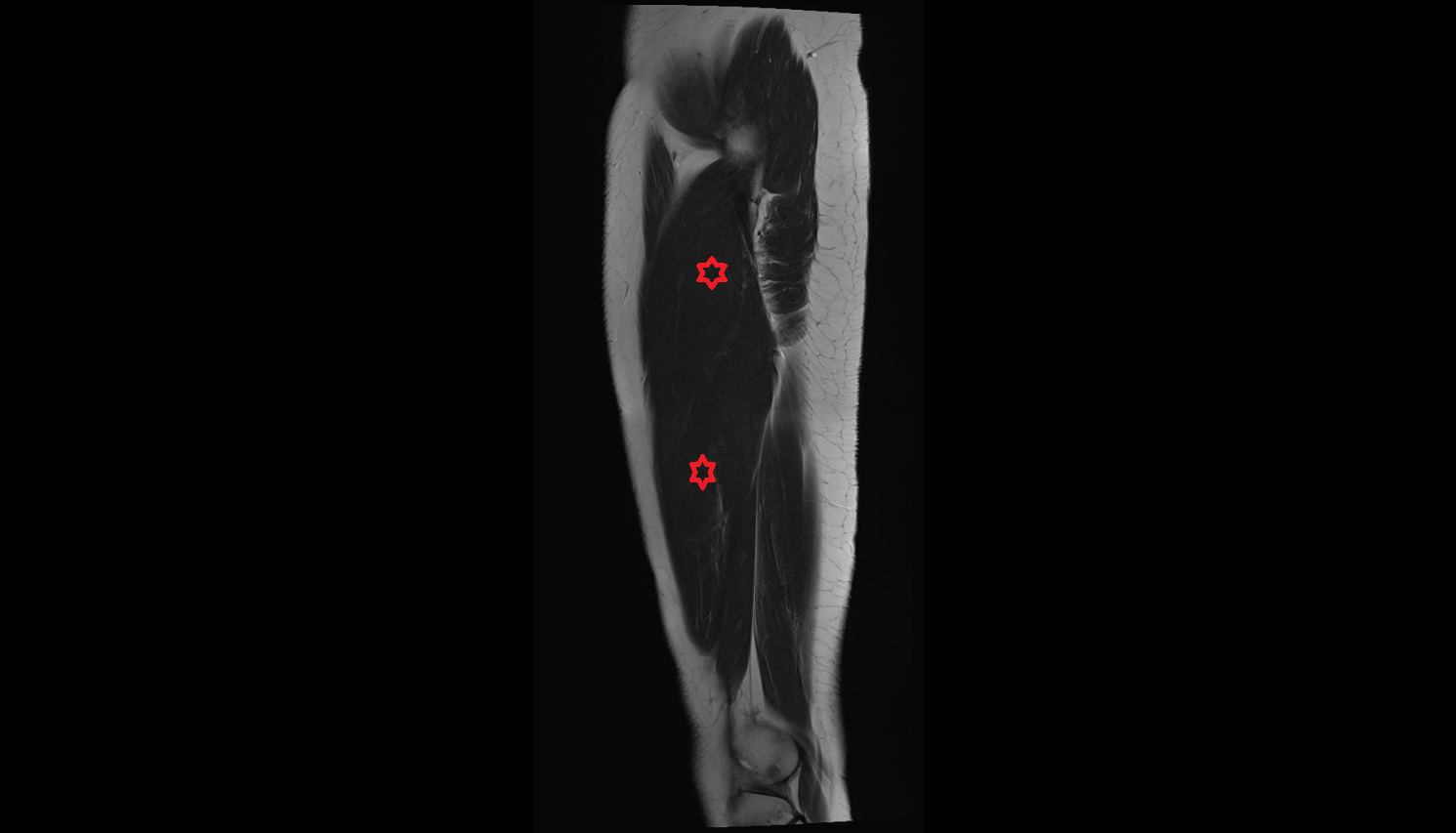 Vastus lateralis muscle sagittal  cross sectional anatomy 3T radiology  anatomy image-img-00000-00000