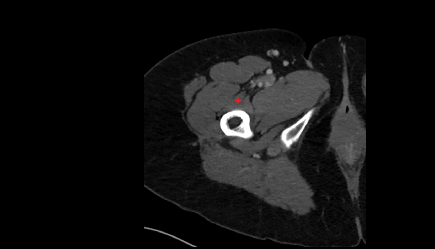Vastus medialis muscle CT axial