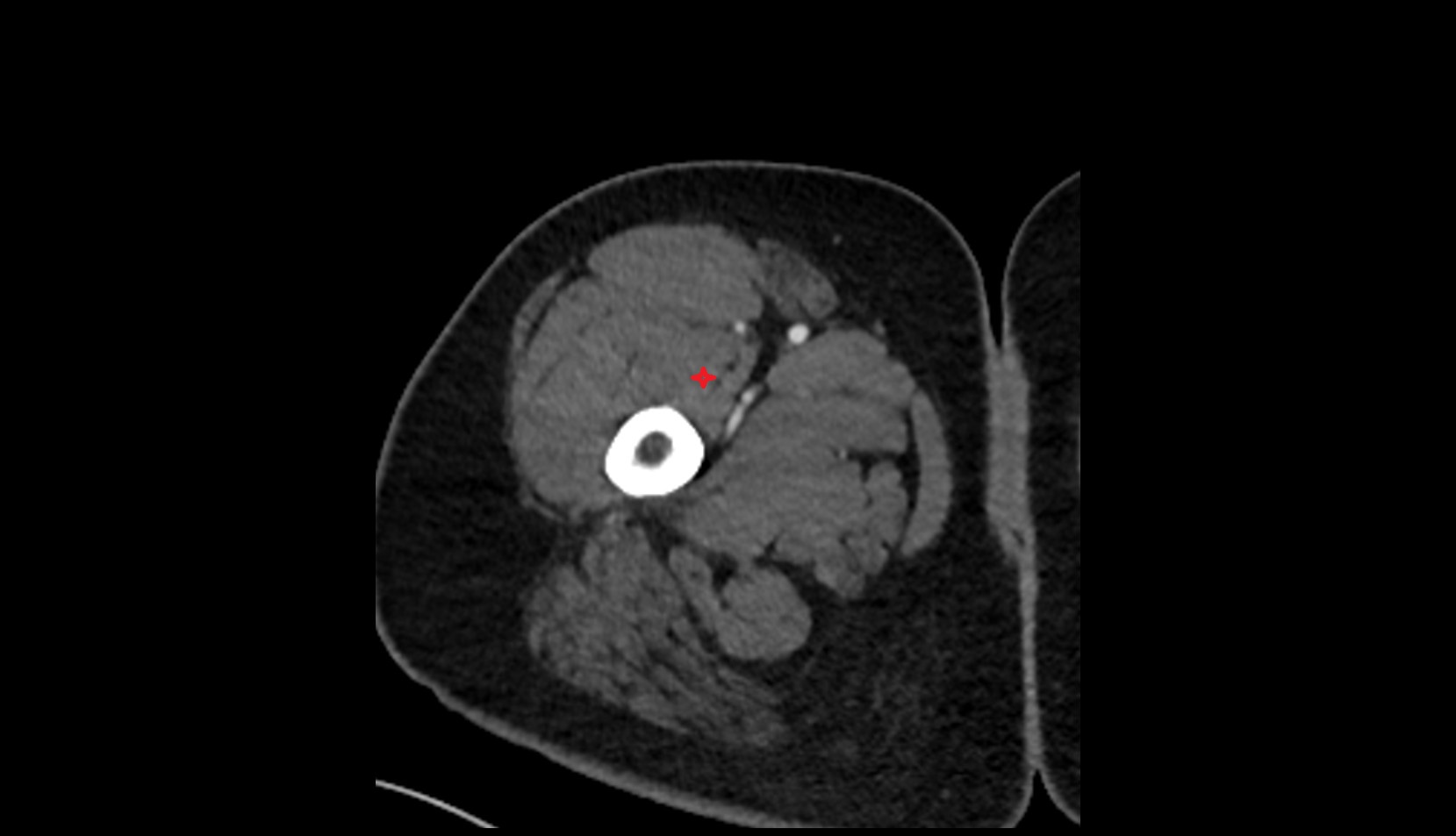 Vastus medialis muscle CT axial 1