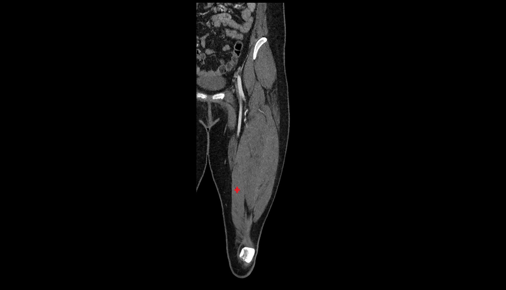 Vastus medialis muscle CT  coronal