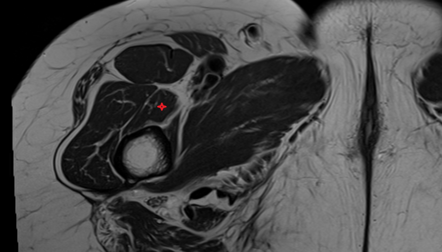 Vastus medialis muscle mri axial  anatomy  image-img-00000-00000