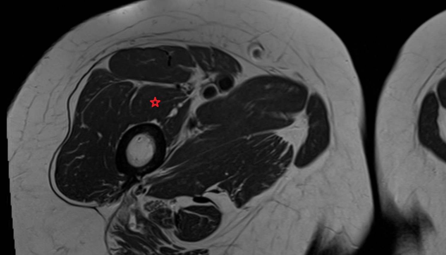 Vastus medialis muscle mri axial  anatomy  image-img-00000-00000_00001