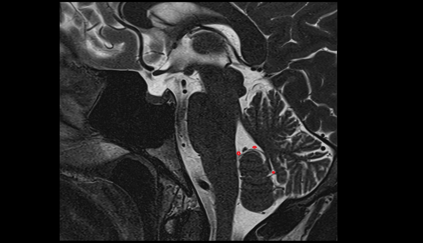 Vein of cerebellomedullary cistern