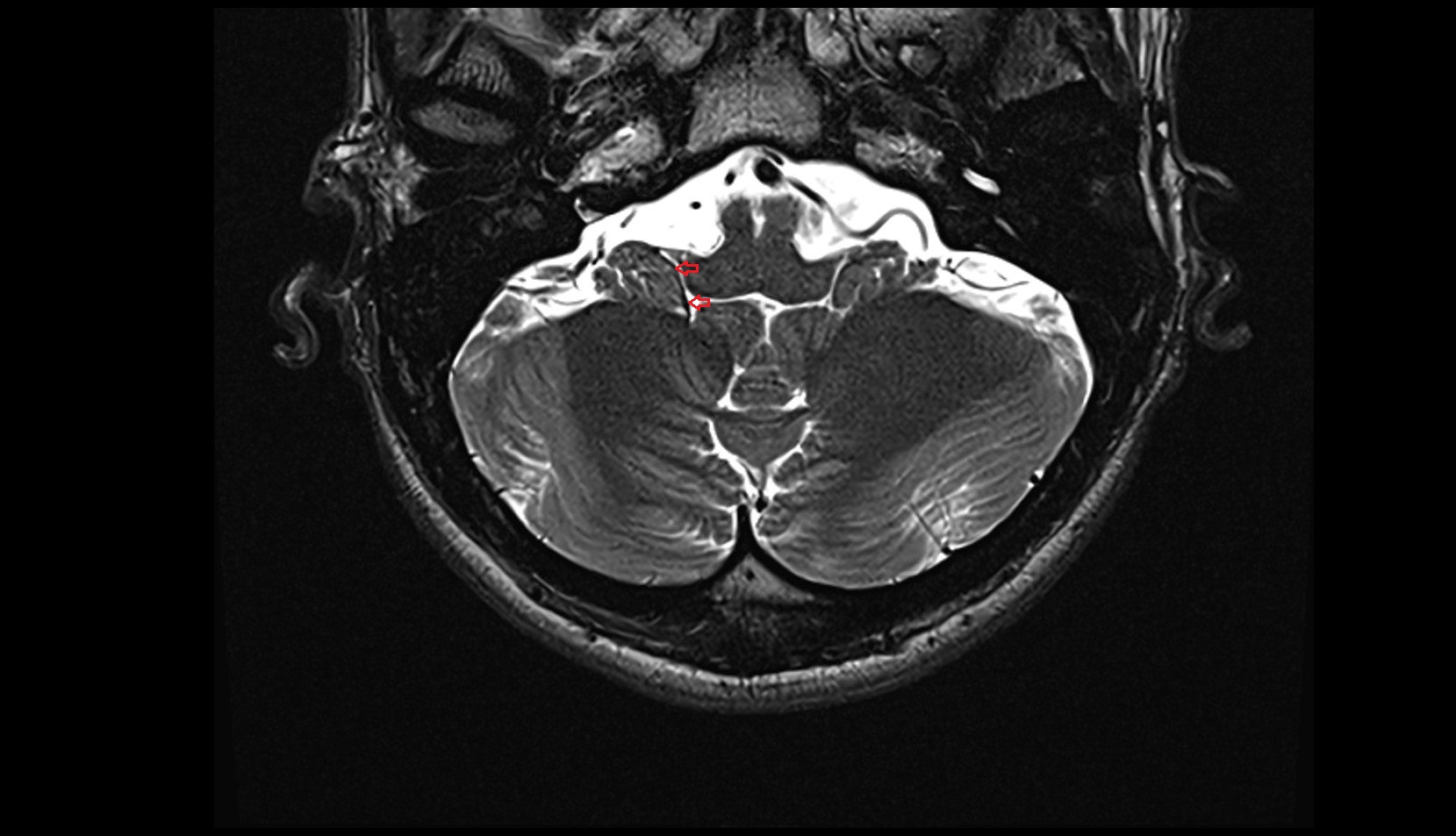 Vein of lateral recess of fourth ventricle Axial MRI 3T image