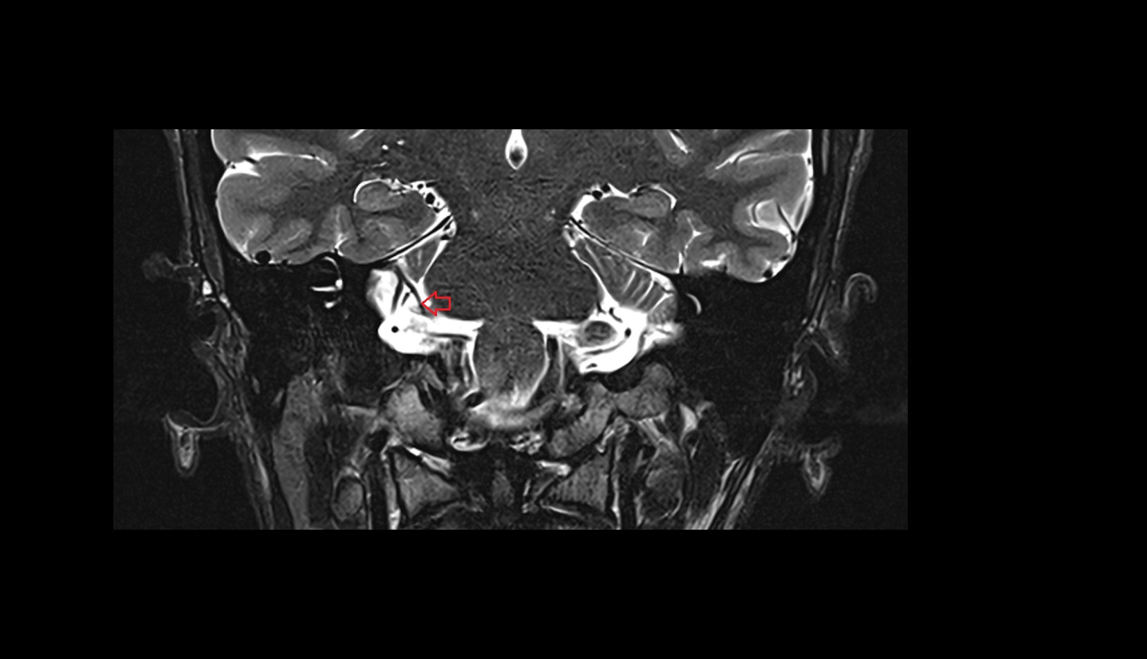 Vein of lateral recess of fourth ventricle coronal MRI 3T image