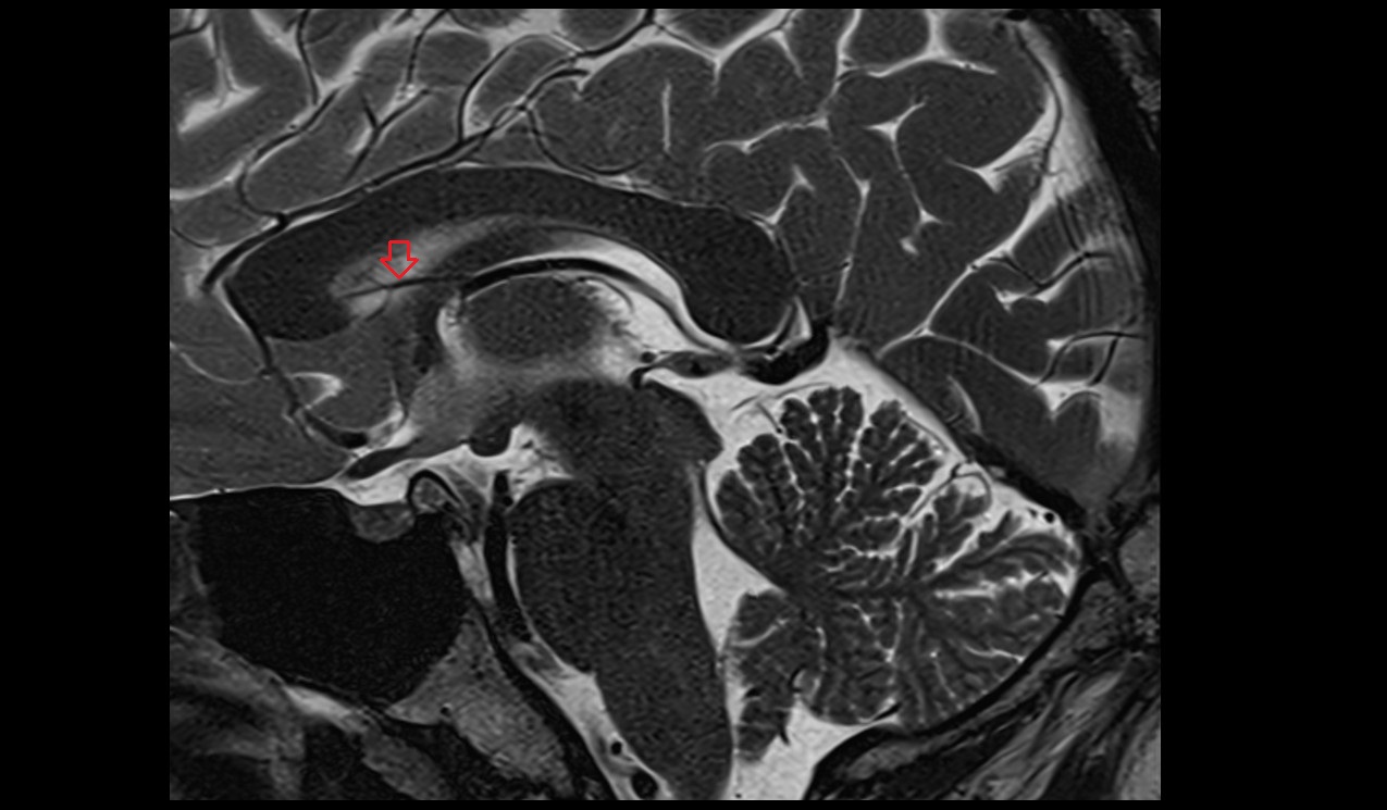 Vein of septum pellucidum MRI 3T sagittal image