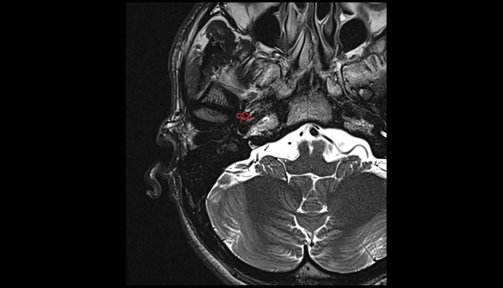 Venous plexus of foramen ovale MRI 3T axial image