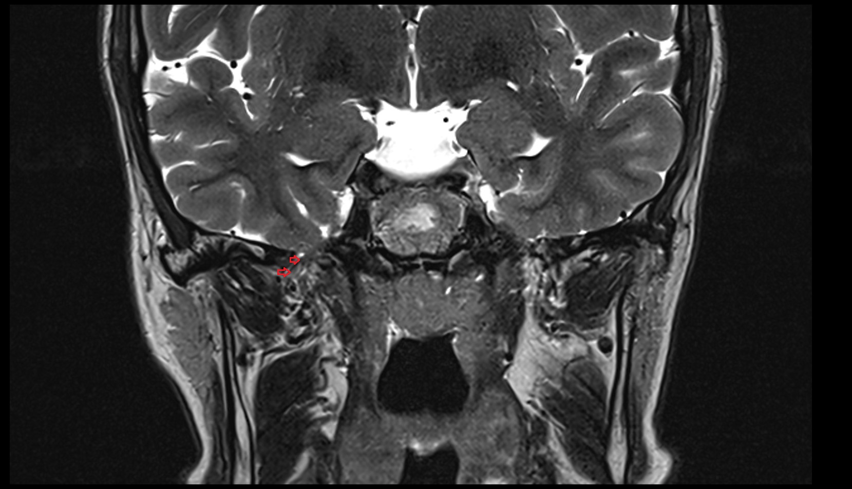 Venous plexus of foramen ovale MRI 3T coronal image