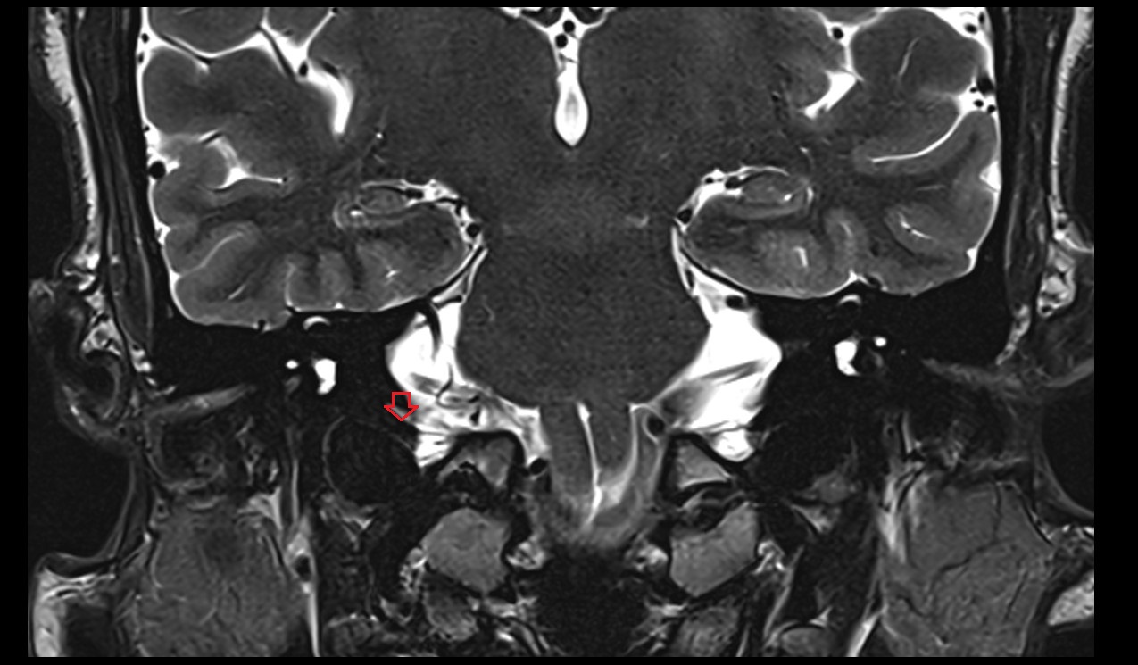 Venous plexus of hypoglossal canal MRI 3T coronal image