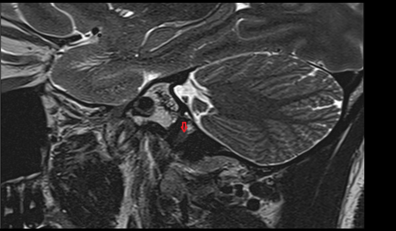 Venous plexus of hypoglossal canal MRI 3T sagittal image