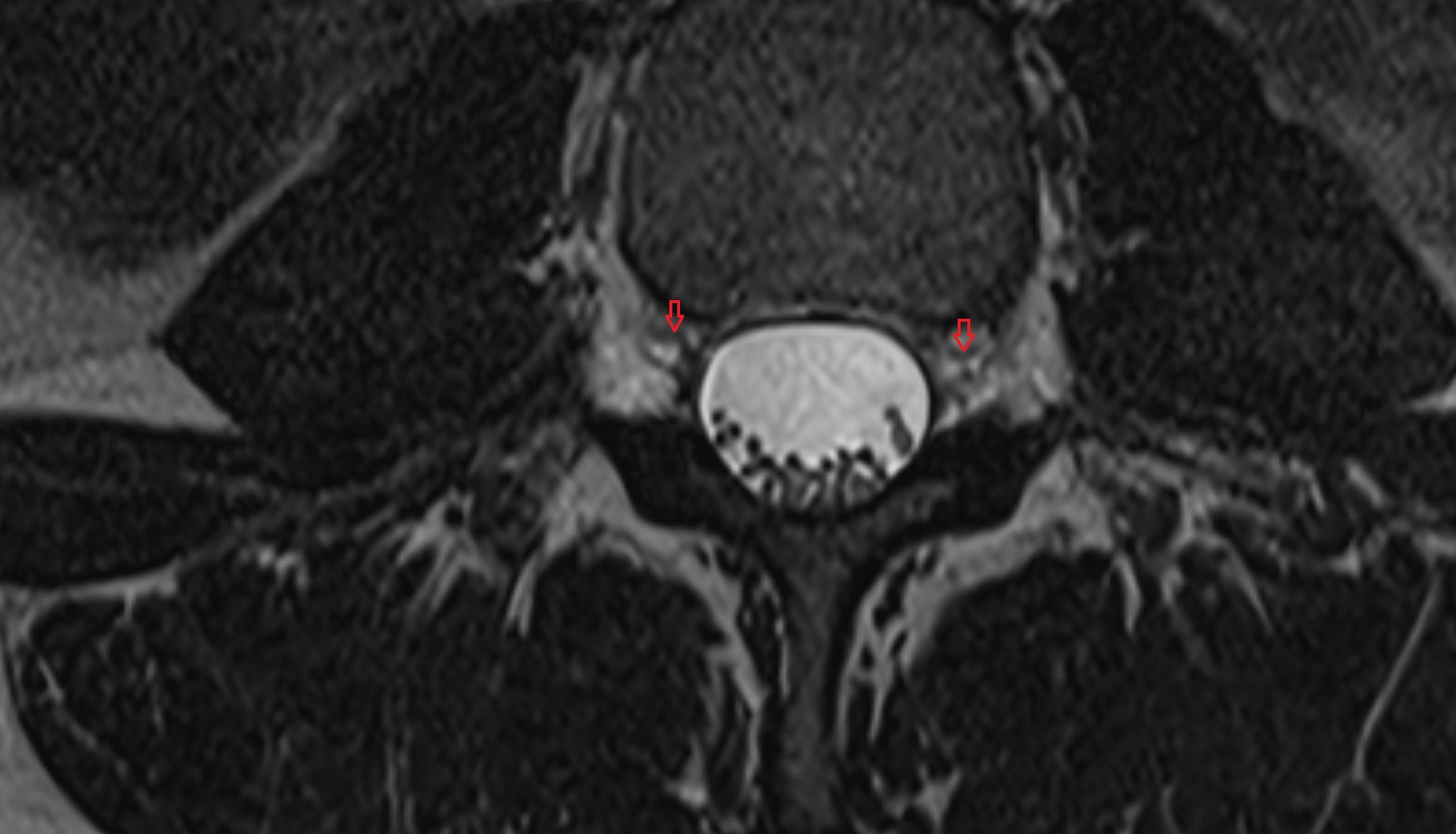 Ventral exiting nerve root  MRI axial  anatomy  image-img-00000-00000