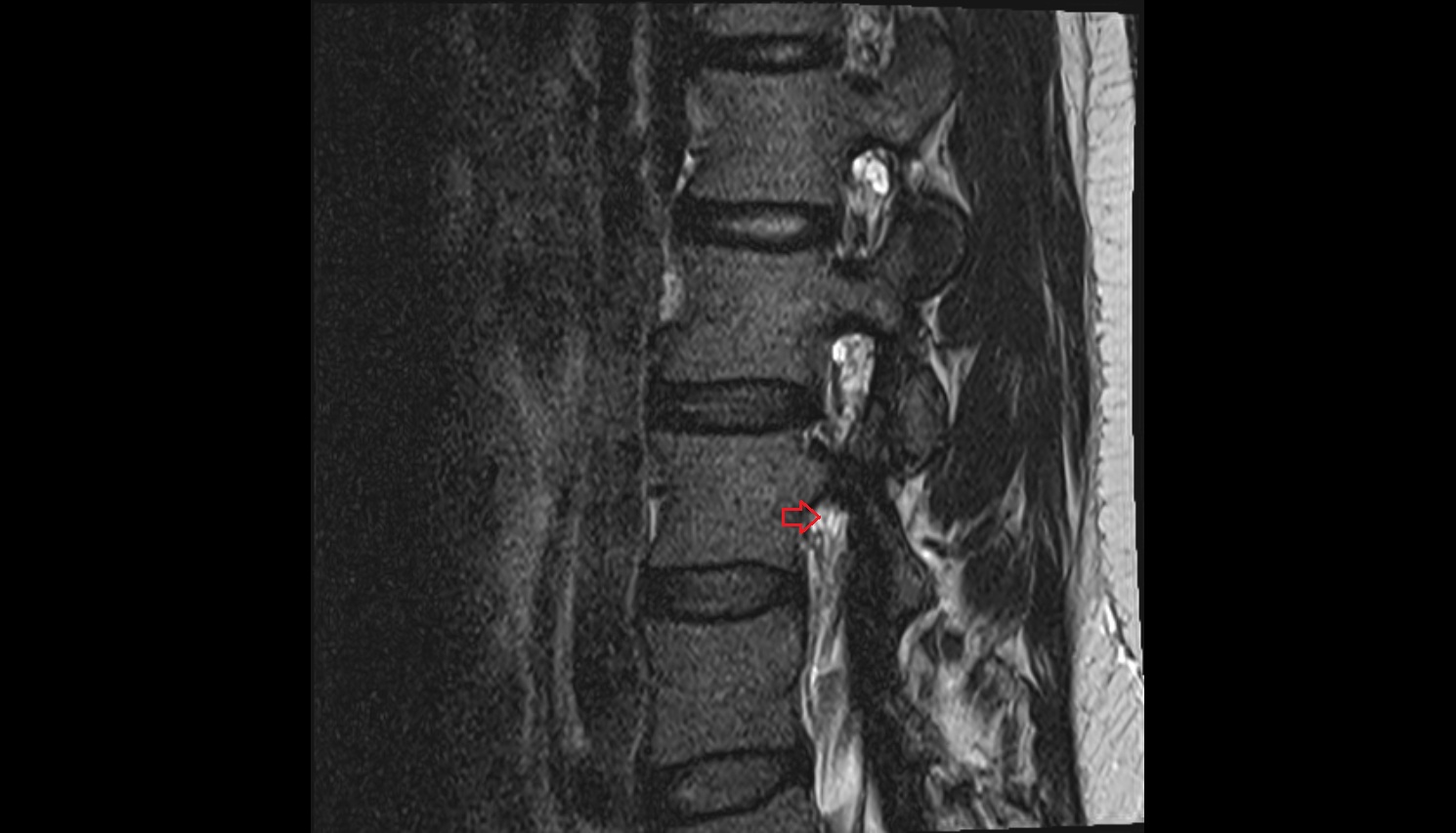 Ventral exiting nerve root  MRI sagittal  anatomy  image-img-00000-00000