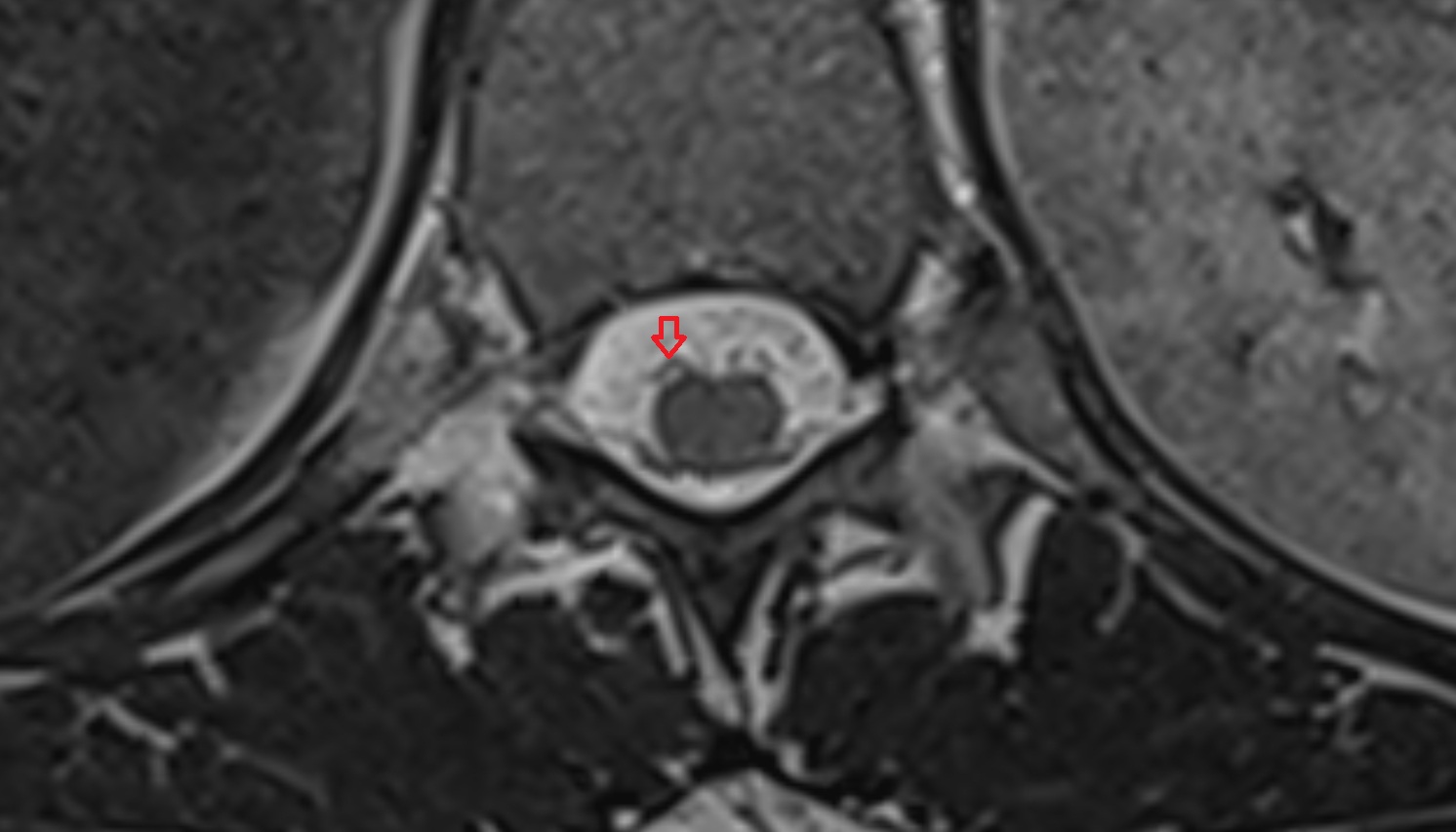 Ventral root of spinal nerve  mri axial  image -img-00000-00000