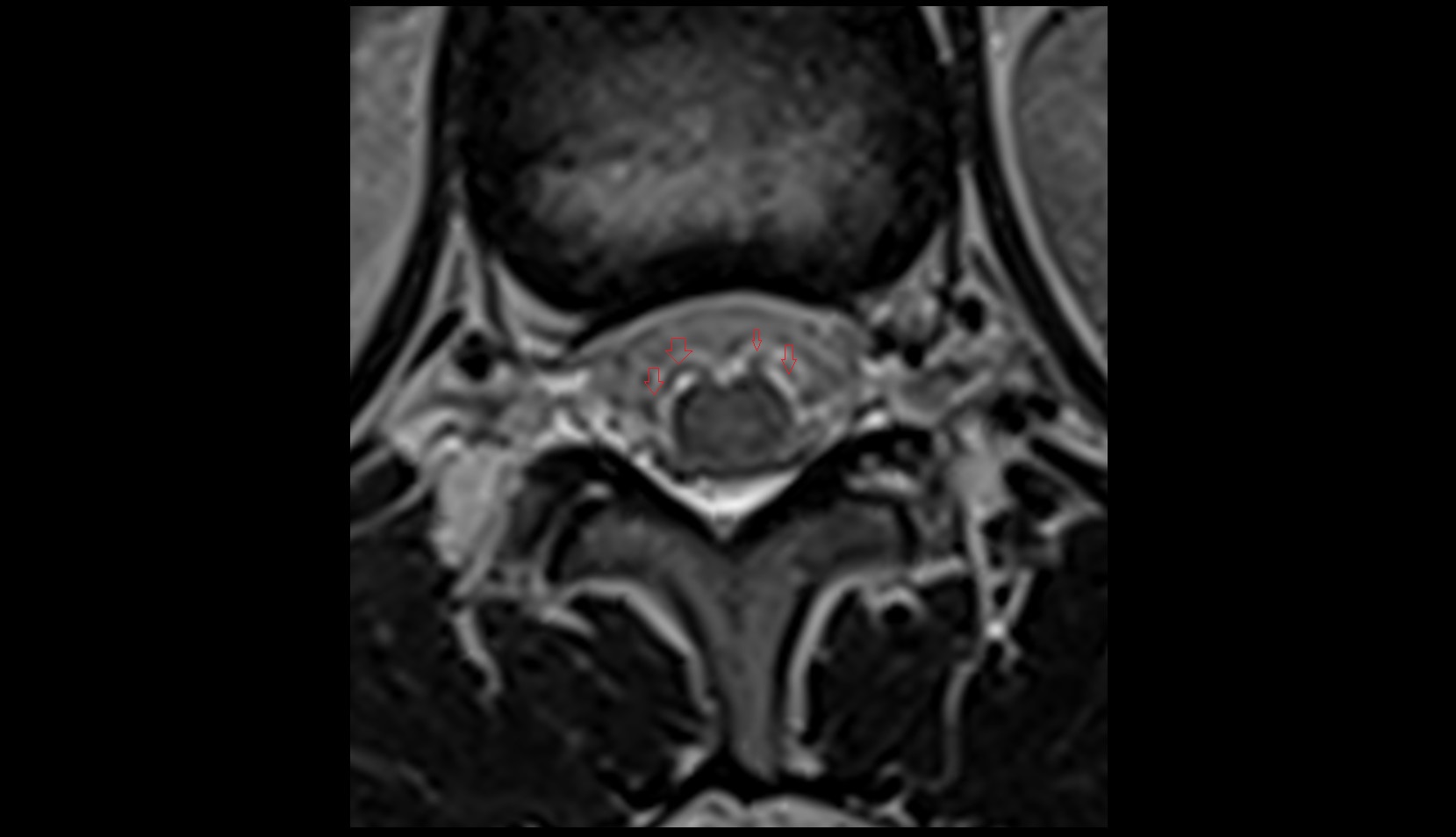 Ventral root of spinal nerve mri axial image