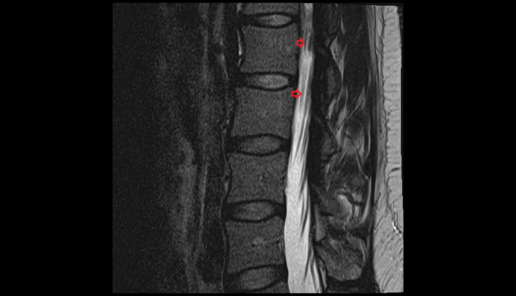 Ventral root of spinal nerve sag mri