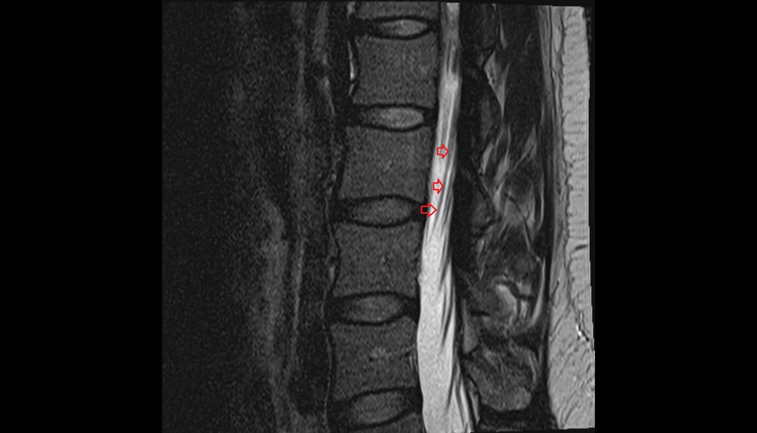 Ventral traversing nerve root  MRI sagittal  anatomy  image-img-00000-00000_00001