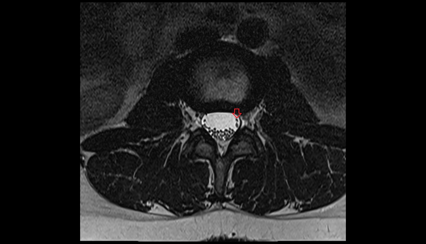 Ventral traversing root